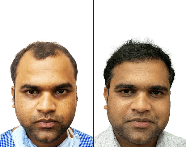 Best hair transplant doctors deals