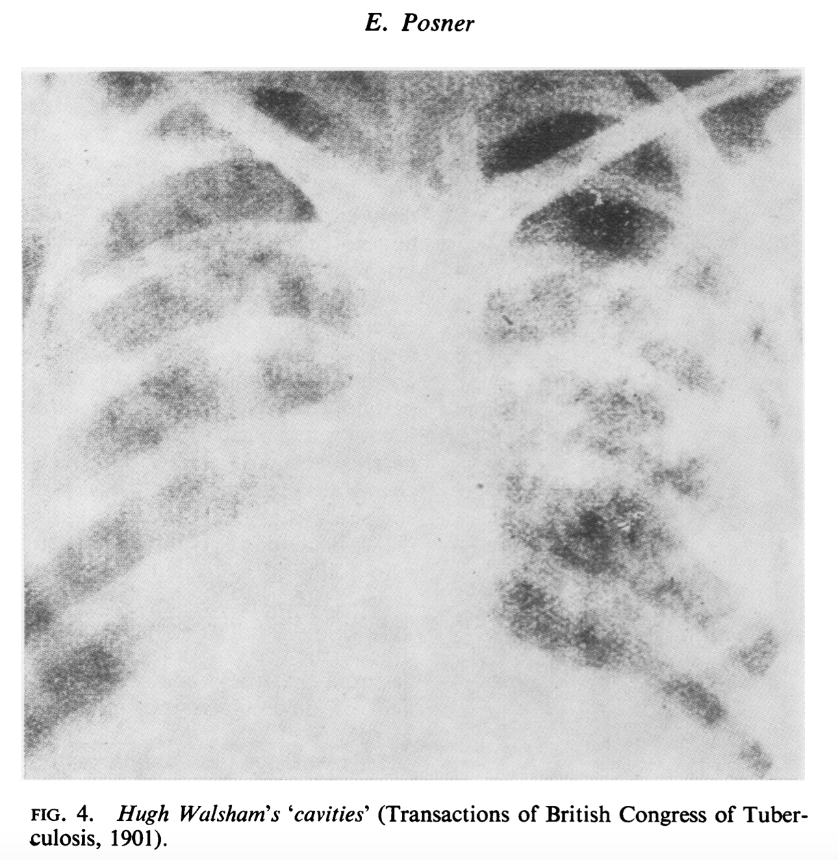Google搜尋關鍵字:the first image of chest x-ray, 1901 (圖片來源:BMJ)