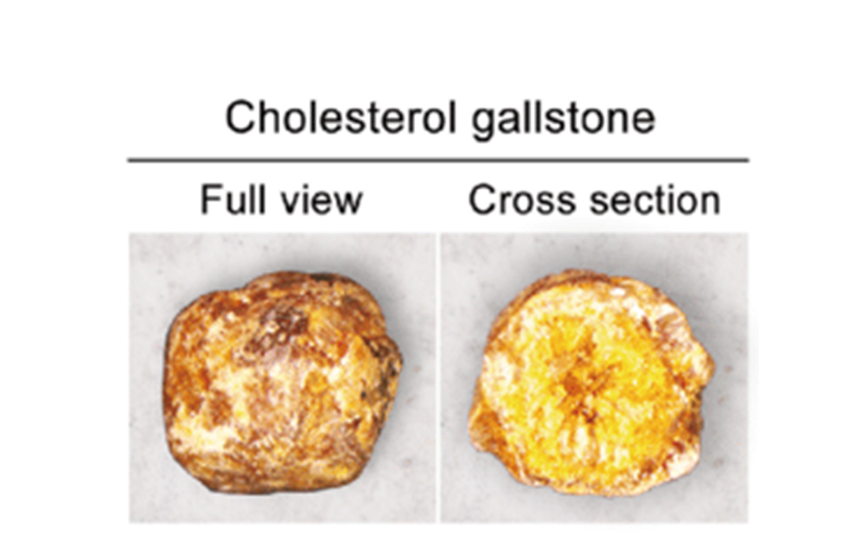Figure 2. Image of cholesterol gallstone. Source: Choi et al., 2019