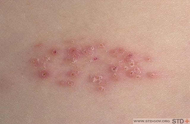 Mild Herpes. The symptoms of mild genital herpes or… | by Ivan Kostenko |  Medium
