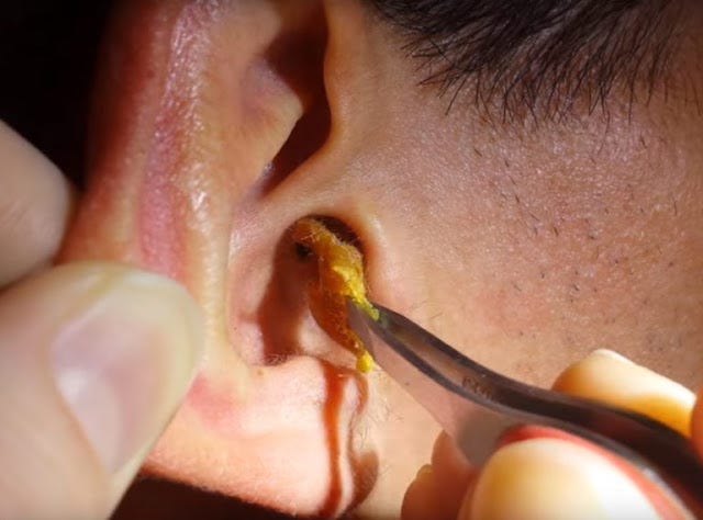 What is the fastest way to remove ear wax? | by sanjeev SINGH | Medium