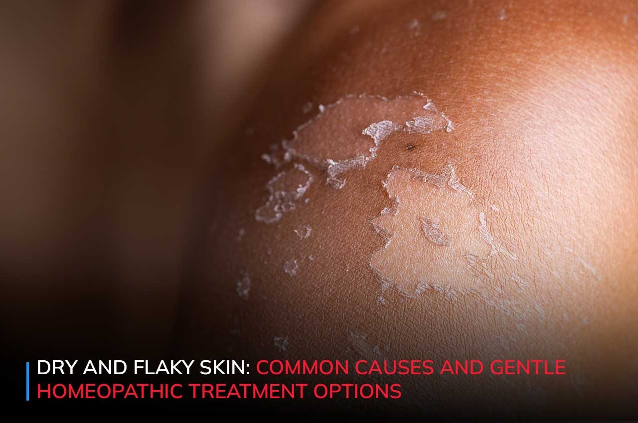 Dry and Flaky Skin: Common Causes and Gentle Homoeopathic Treatment Options