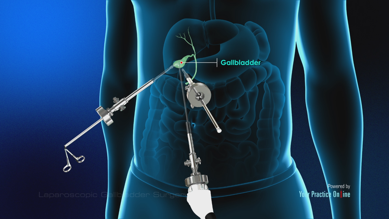 What Causes Gallstones?