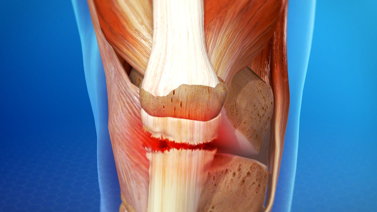 Ruptura patelarnog ligamenta — iskustvo