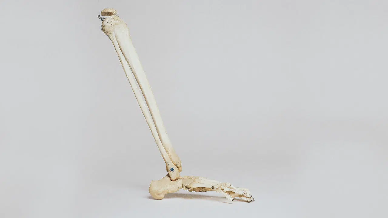 The Proper Way To Showcase Metal Rod Fibula Complications