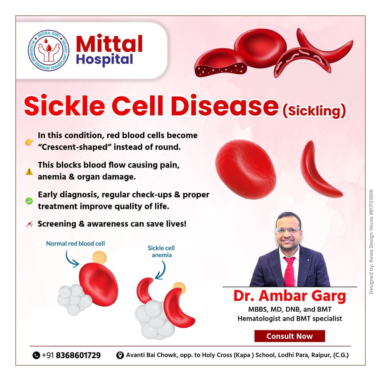 Understanding Sickle Cell Disease (Sickling) — Causes, Symptoms, and Treatment