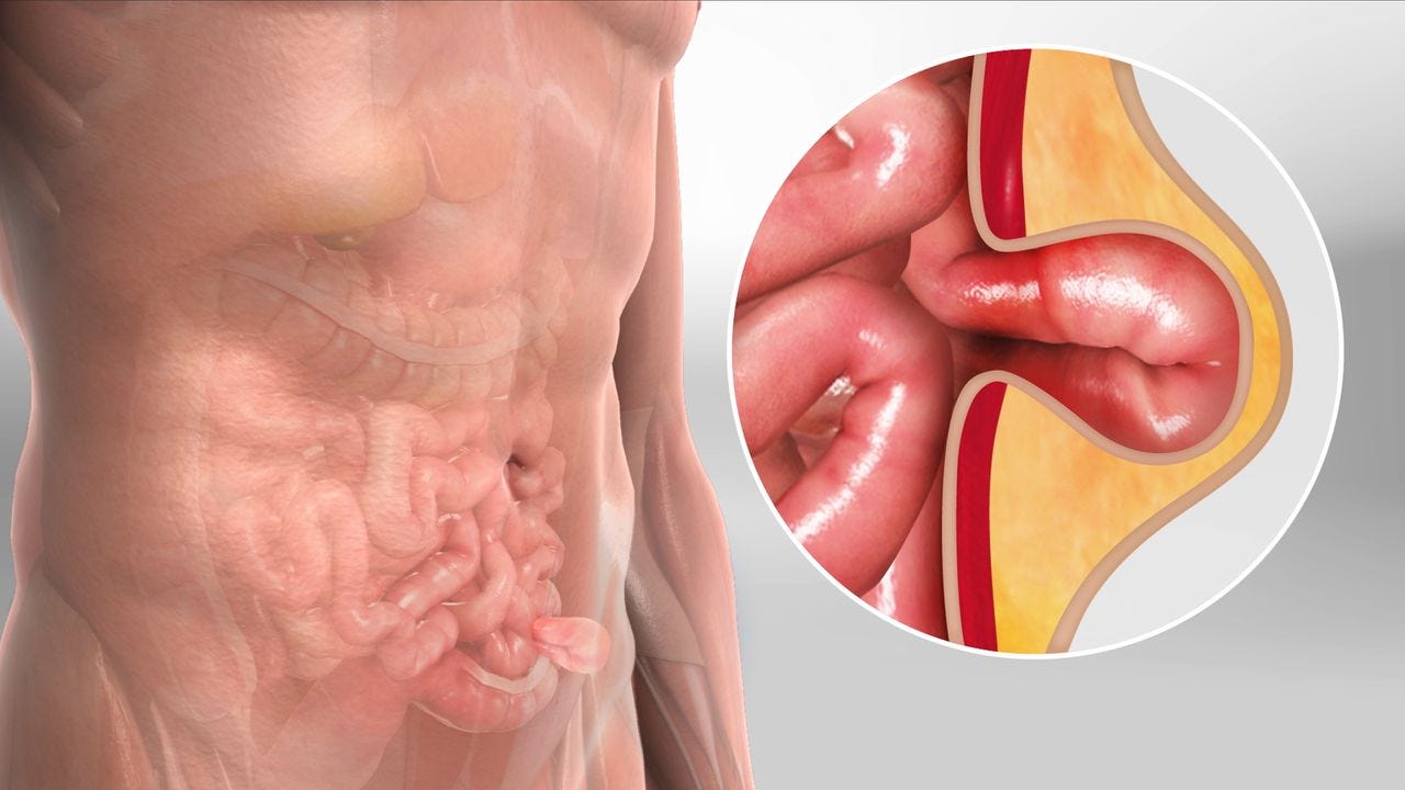 Who Is More Likely to Develop Hernia?