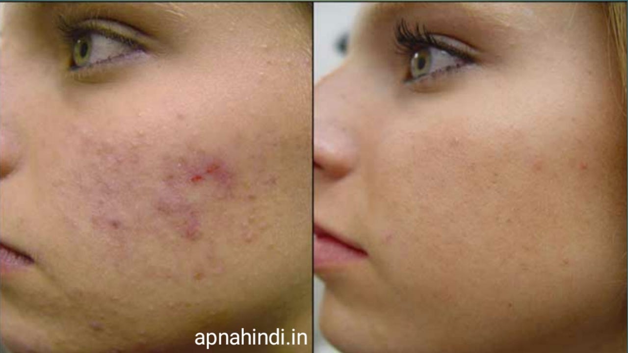 Multani mitti se chehre ke dag dhabbe kaise hataye | How to remove blemishes from face with multani…