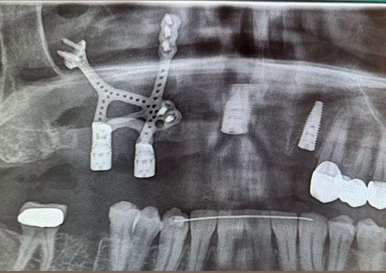When a Zygomatic Implant Is Not the Right Solution: A Custom Subperiosteal Implant for Severe Bone…