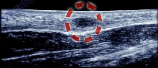 Plantar fibroma ultrasound hotsell