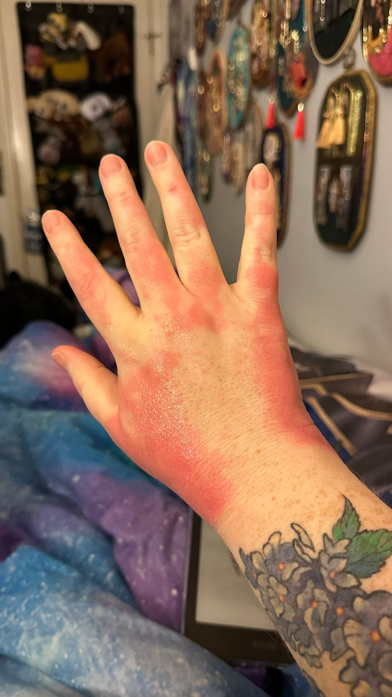 Still, though, the issue remained contained to the topside of my hands.