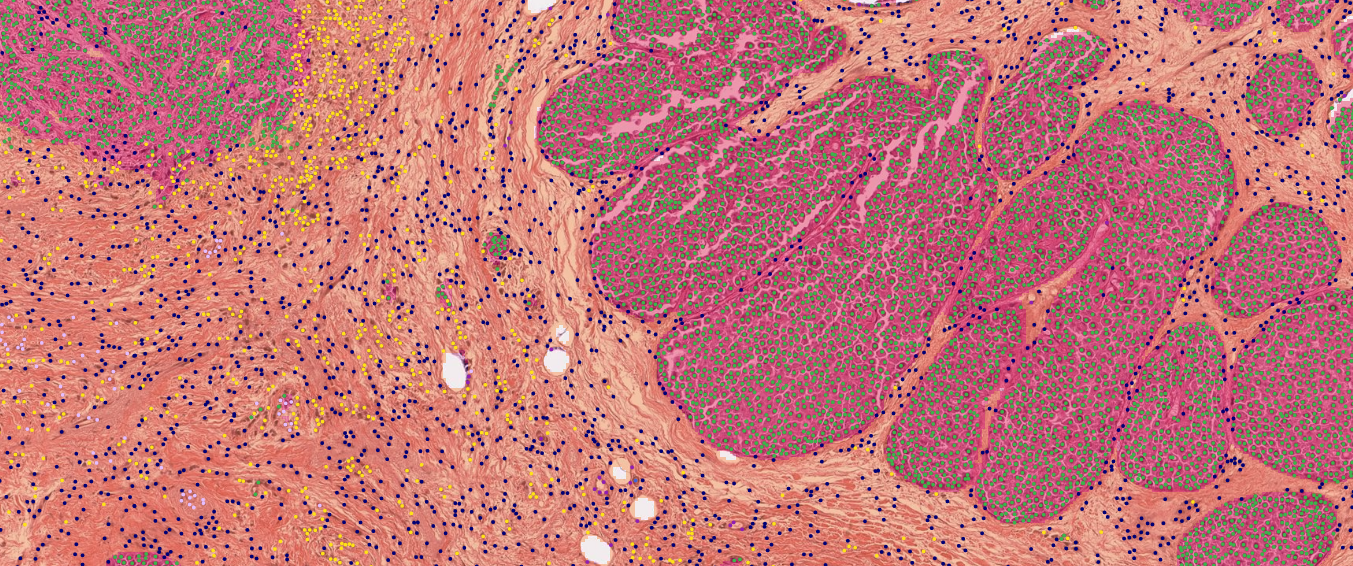The wonderful tumor microenvironment (TME) — zooming into a pathology image uncovers diverse tissue structures and cells that form them. Lunit SCOPE aims to turn such image data into understandable numbers and statistics, for improved prognosis and subsequent patient survival. (Sample taken from TCGA BRCA)