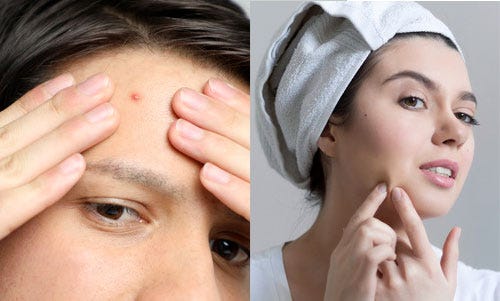 Unraveling the Causes of Chin Acne: What You Need to Know  by youpeng 