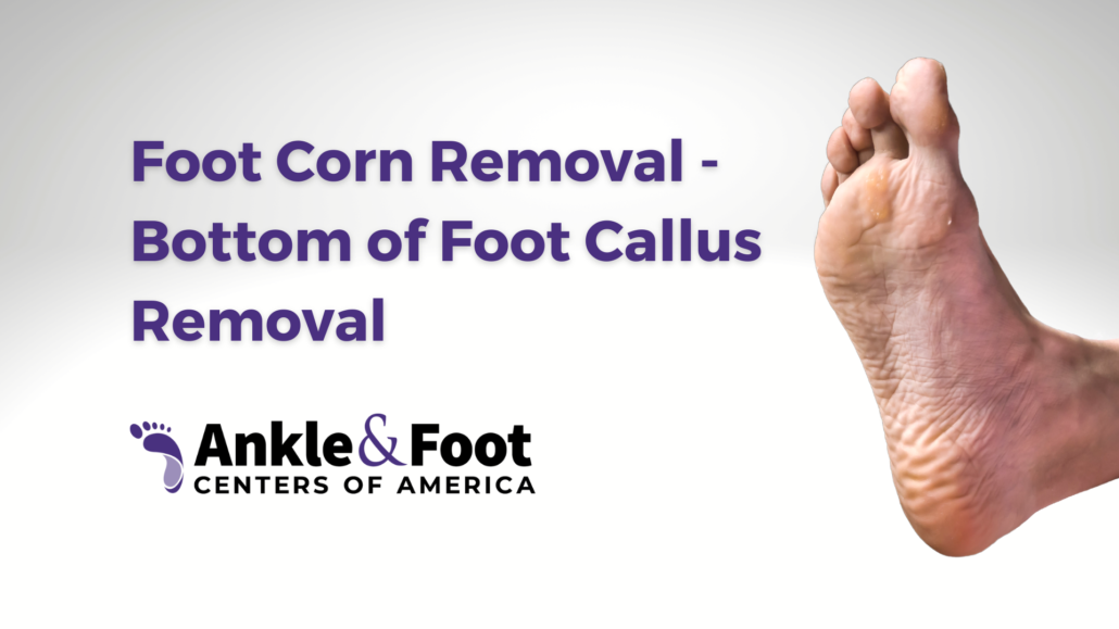 CORN & CALLUS REMOVAL IN SINGAPORE - Physio & Sole