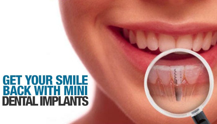 Get Your Smile Back With Mini Dental Implants | by Perio Implant Center |  Medium
