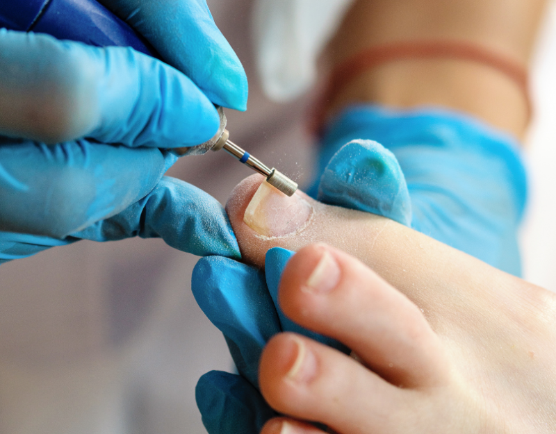 Effective Ingrown Toenail Treatment and Removal by North London Foot