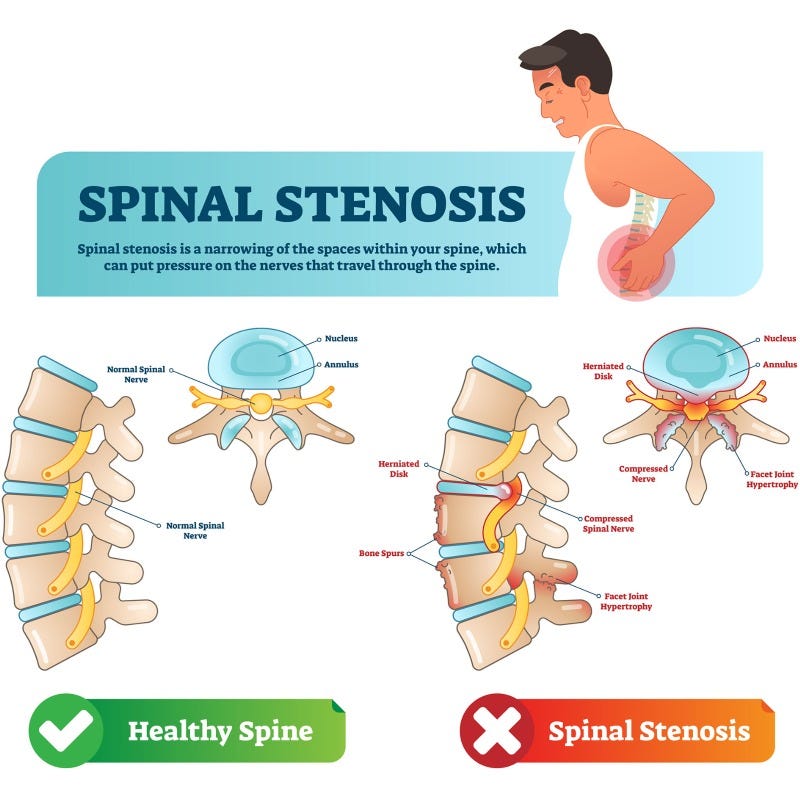 gabapentin for stenosis pain