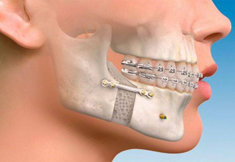 What is the difference between pendex and T Rex appliances? by All