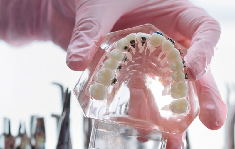 How much do braces cost in South Africa? by Jason Edwards Medium