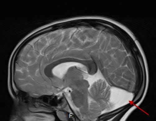 Benign enlargement of the subarachnoid spaces (BESS) | by salvo fedele ...
