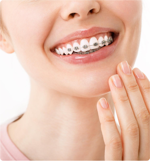 Braces and Your Lifestyle What You Need to Adjust in Dubai by anaya Jul, 2024 Medium