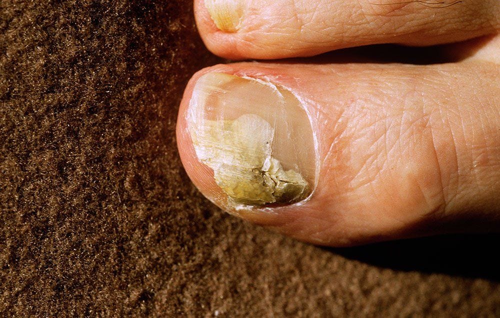 REAL cause of Toenail fungus revealed and How to Eliminate it in less