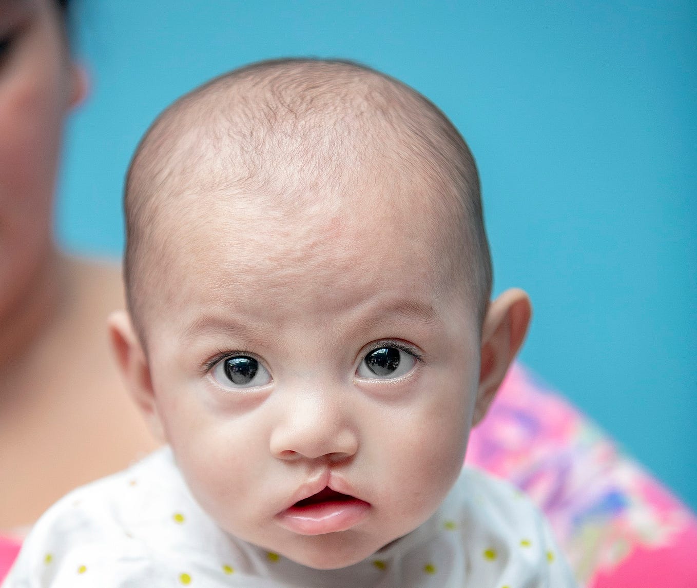 An infant with a cleft lip looks into the camera.