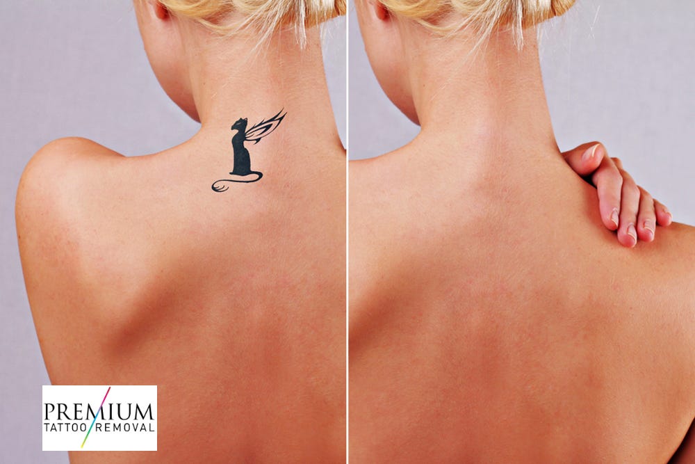 Tattoo Removal Tips, Questions and Answers - MMSCENE