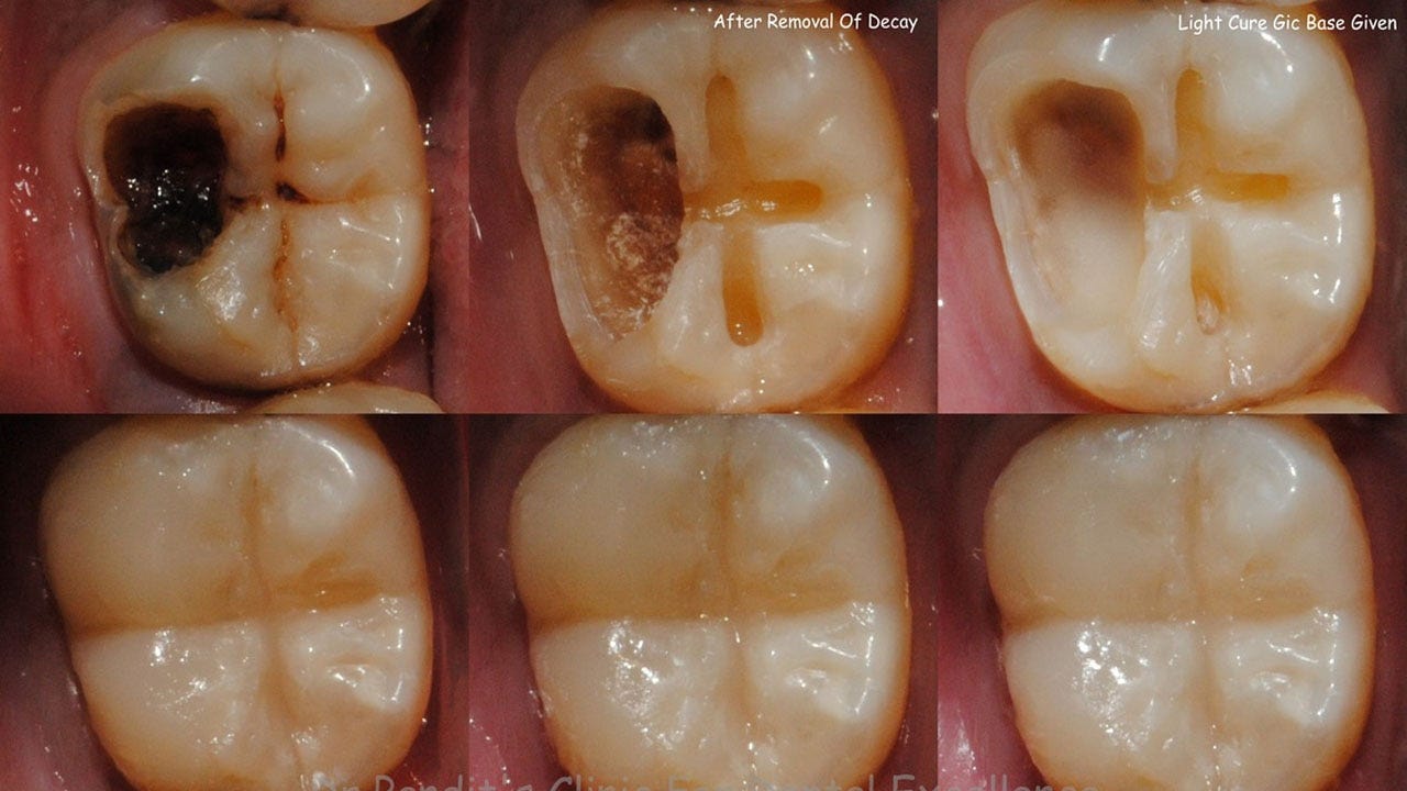 Understanding Dental Cavities Causes Prevention and Treatment | by ...