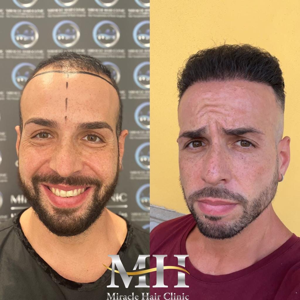 A Comprehensive Guide To Hair Transplant In Turkey — Miracle Hair