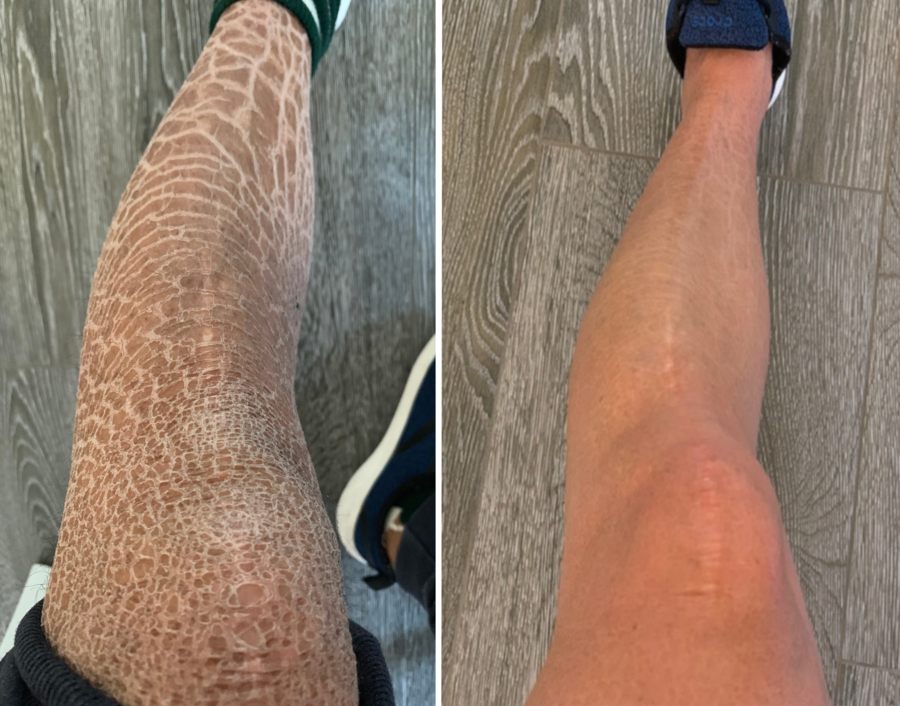 First Foundation For Ichthyosis SR Lotion Medium