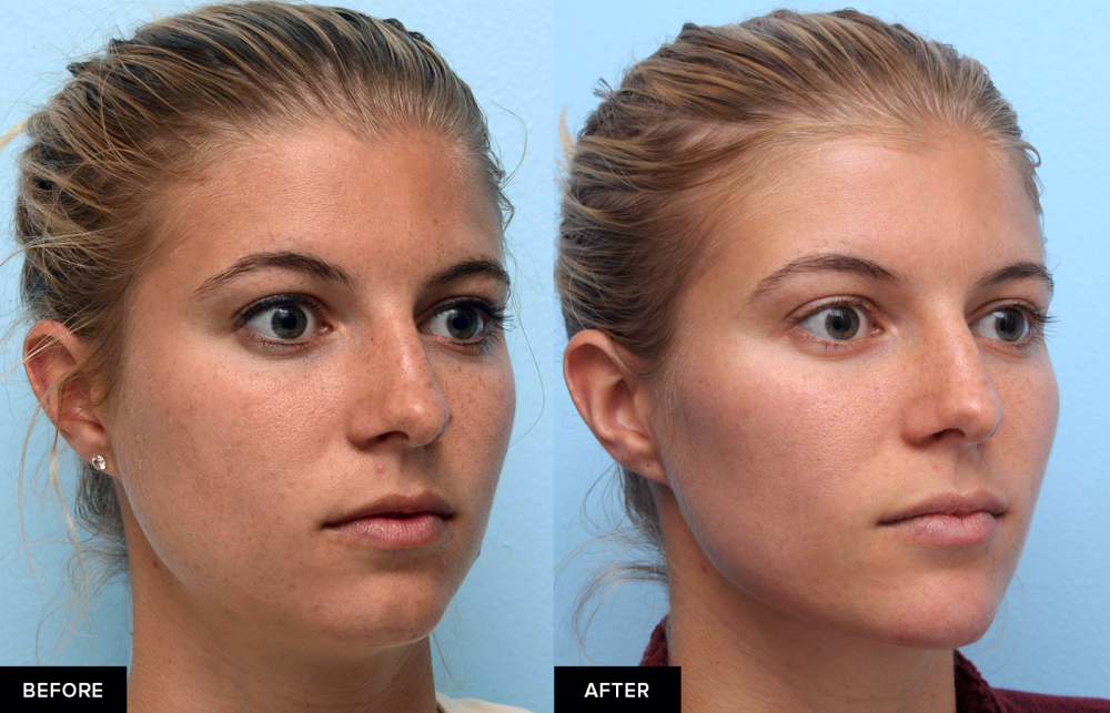 Discover The Magic Of PDO Threads A Quick Guide To Achieving Youthful 