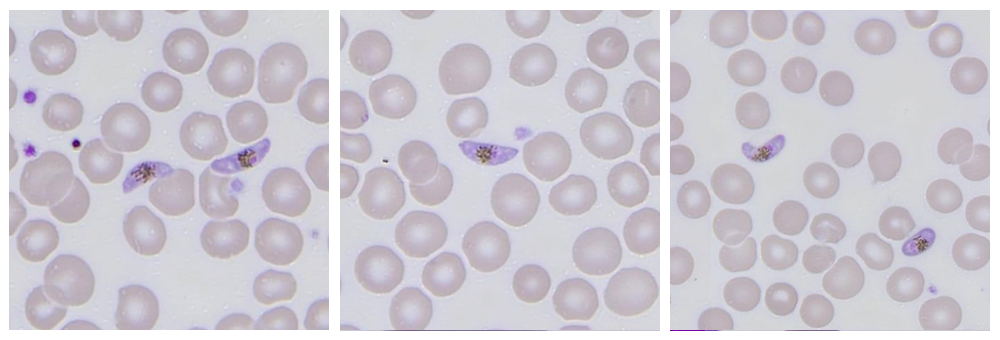 RBC inclusions unveiled: Why peripheral smear still matters? | by ...