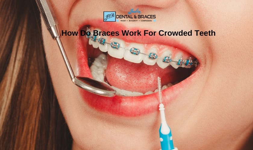 Affordable Braces Near You Achieve a Perfect Smile on a Budget Justin Dental and Braces Medium