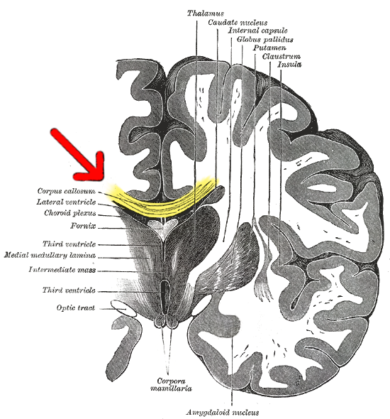 Living with Two Brains — Life Without Your Corpus Callosum