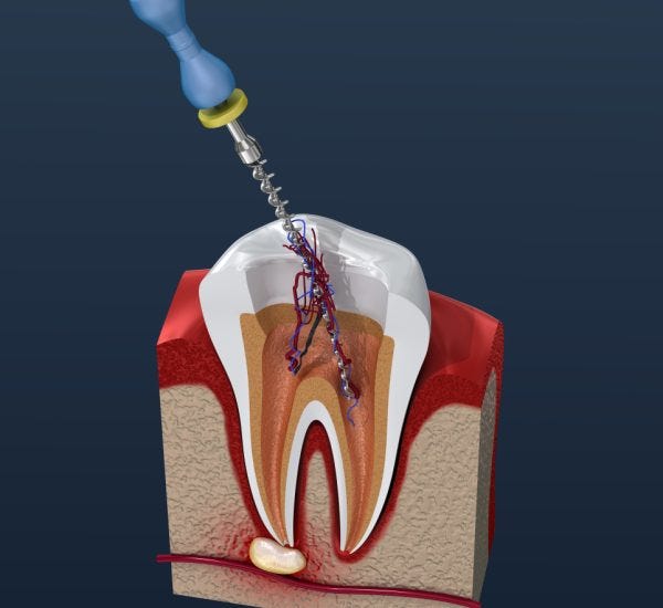 Exploring Root Canal Treatment in Petlad Your Comprehensive Guide by