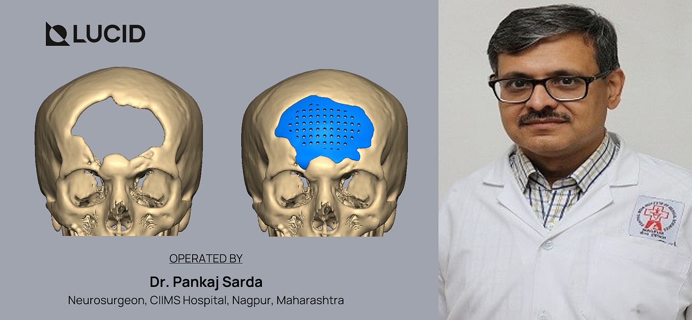 Custommade Titanium Implant Cranioplasty — A Case Study by Dr