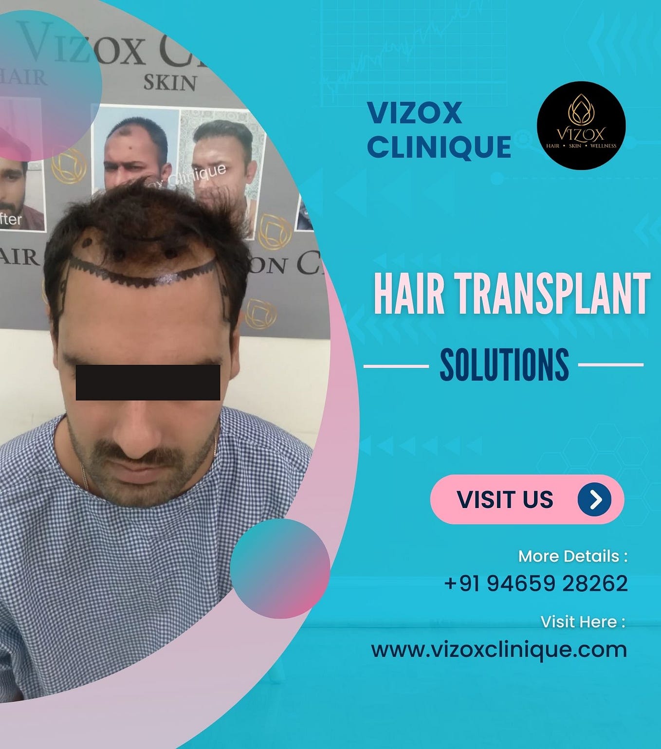 The Ultimate Guide To After Hair Transplant Care Dos And Donts