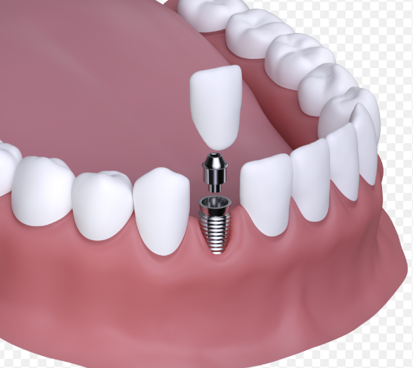 Understanding the Process of Dental Implants by Madrox Asim Medium