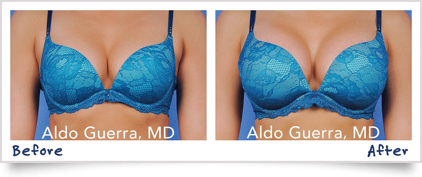 Am I a Good Candidate for Breast Augmentation?, by Guerra Plastic Surgery  Center