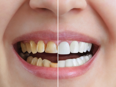 The Truth About Teeth Whitening Treatment In Belleville | by Cosmetic  Dentistry in Belleville | Medium
