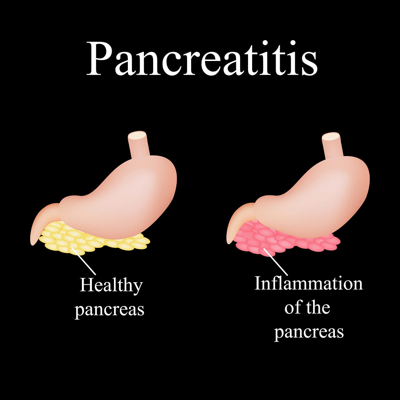 What Is Cirrhosis Of The Liver Cirrhosis Is The Scarring Of Liver what-is-cirrhosis-of-the-liver-cirrhosis-is-the-scarring-of-liver