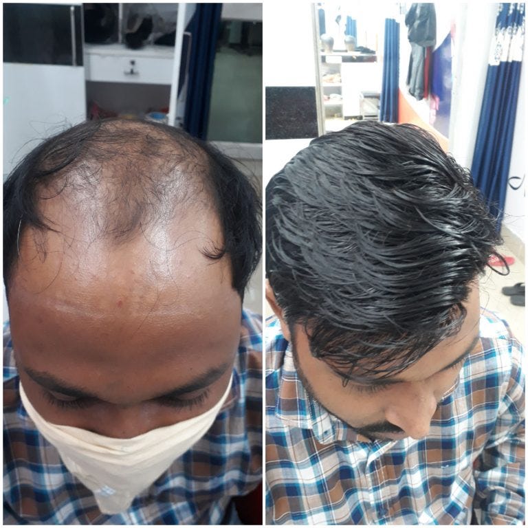 Best Hair Treatment in Bhubaneswar Hairfixsolution Medium