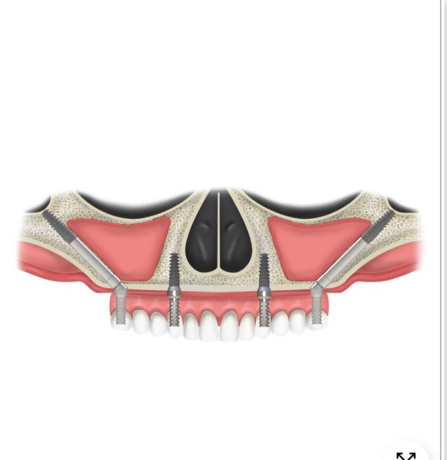 Internal Hex Dental Implant System in Chandigarh Adin Dental Implants