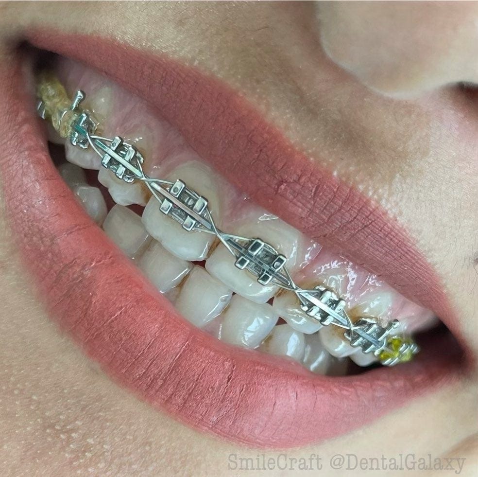 Orthodontic treatment Braces In Pune by Dental galaxy Medium