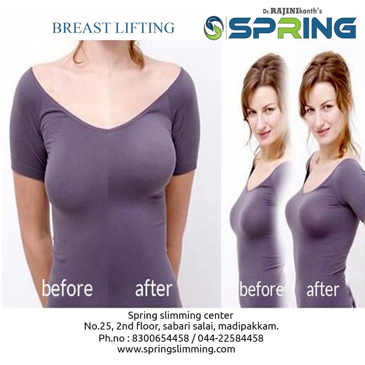 Breast Lift. Breast Lift factors such as pregnancy… by springslimming