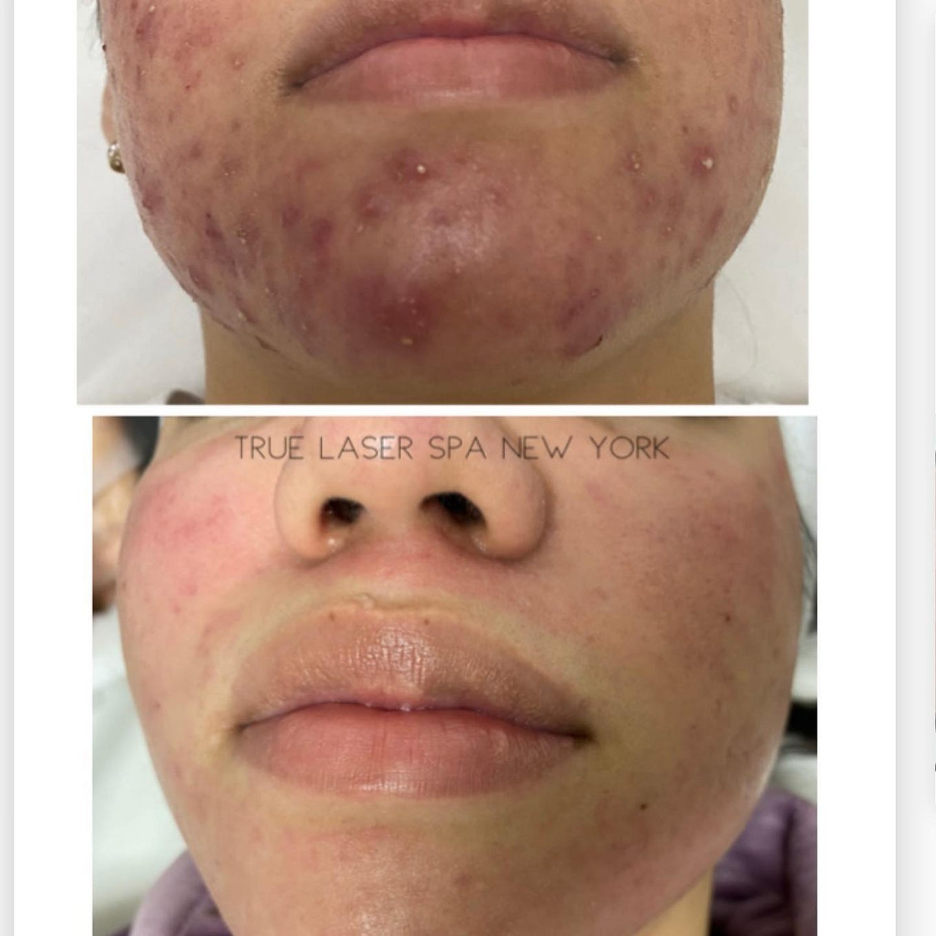 Laser Hair Removal in Queens True Laser Spa New York Medium