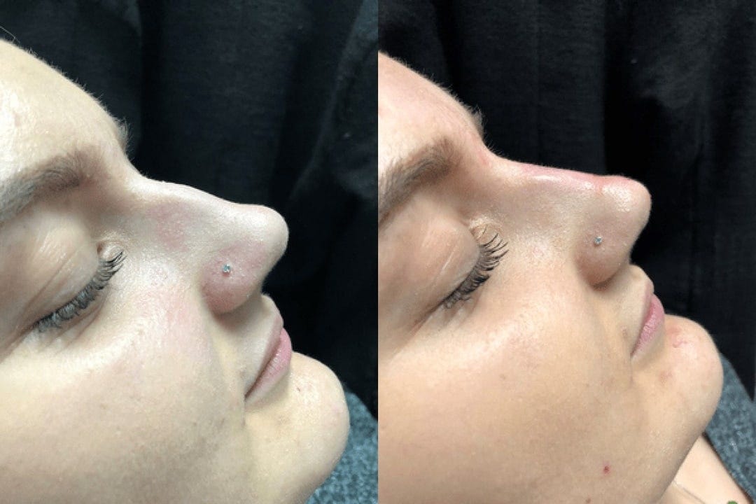 Nose Bump Removal Techniques and Tips for a Flawless Nose by