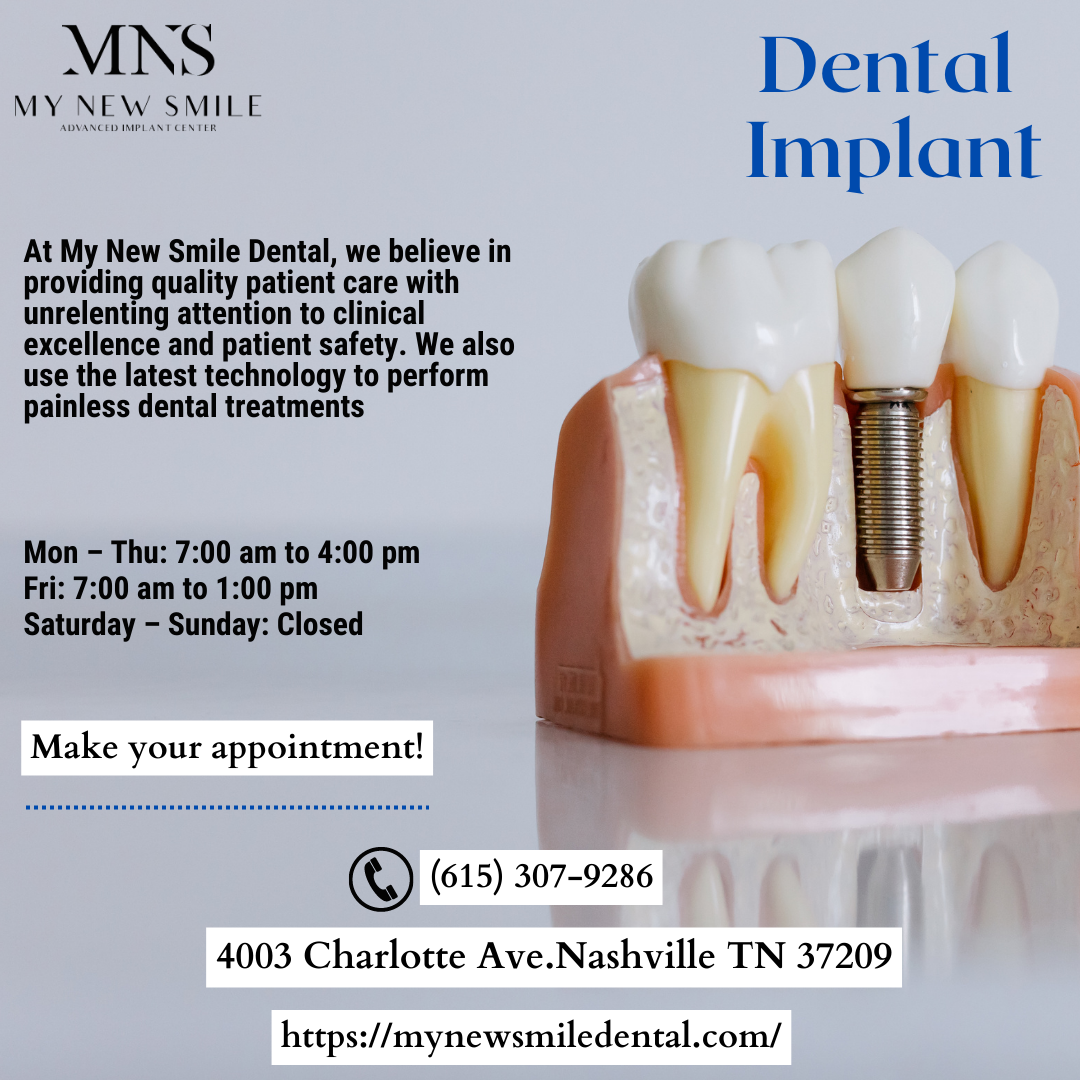 All On 4 Dental Implants Nashville — My New Smile Dental My New Smile Dental Medium