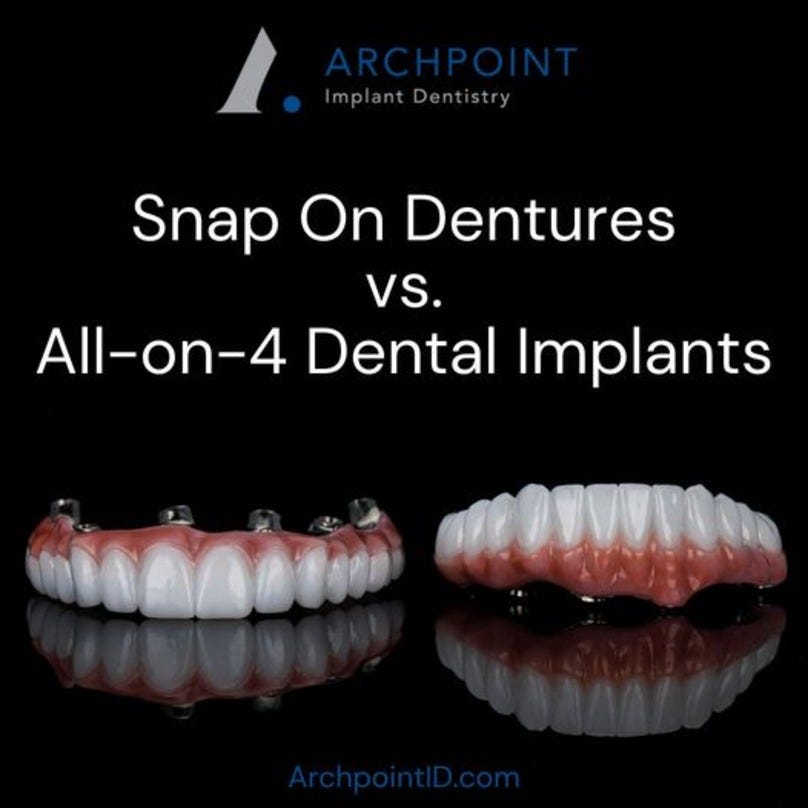 Dental Implant Dallas Transform Your Smile by Archpoint implant